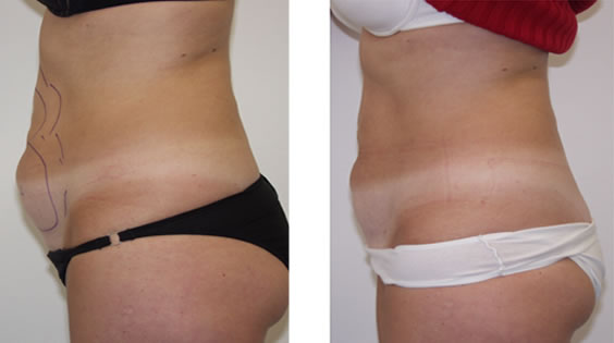 SmartLipo: Laser liposuction and liposculpture