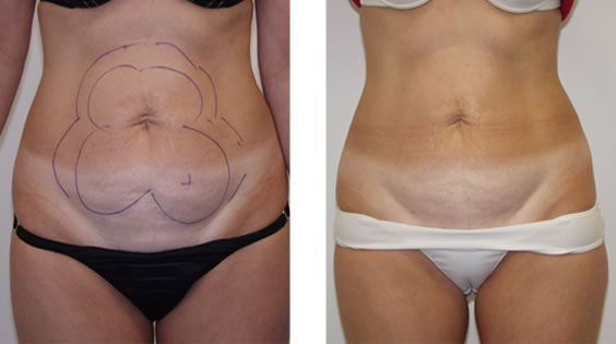 SmartLipo: Laser liposuction and liposculpture