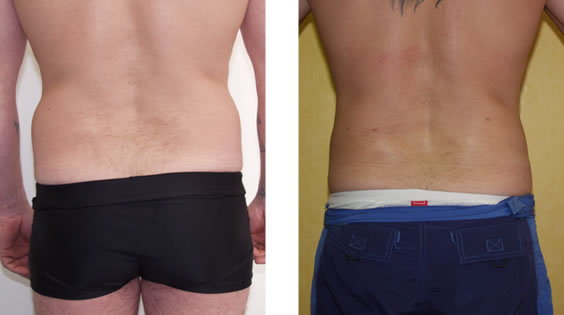 SmartLipo: Laser liposuction and liposculpture