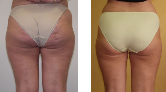 SmartLipo: Laser liposuction and liposculpture