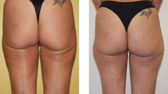 SmartLipo: Laser-Fettabsaugung und Liposkulptur