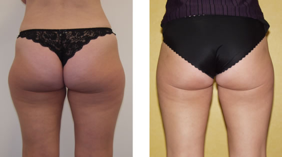 SmartLipo: Laser liposuction and liposculpture