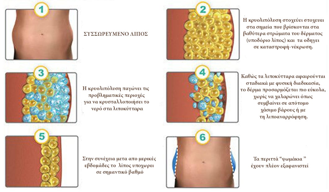 https://www.dermatologist.gr/wp-content/uploads/2016/06/%CE%9A%CF%81%CF%85%CE%BF%CE%BB%CE%B9%CF%80%CF%8C%CE%BB%CF%85%CF%83%CE%B7-%CE%98%CE%B5%CF%83%CF%83%CE%B1%CE%BB%CE%BF%CE%BD%CE%AF%CE%BA%CE%B7.jpg