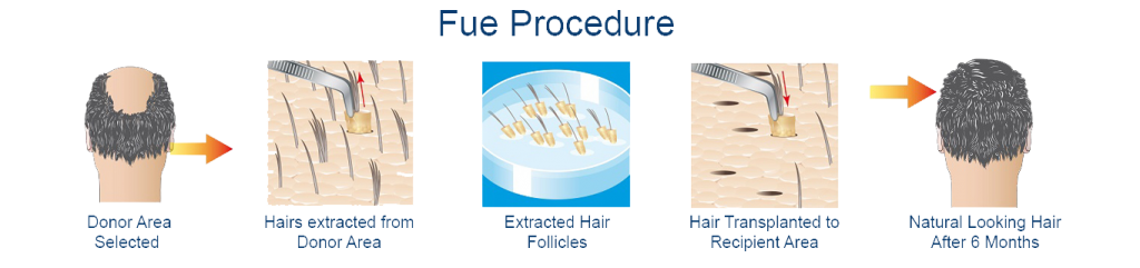 Haartransplantation