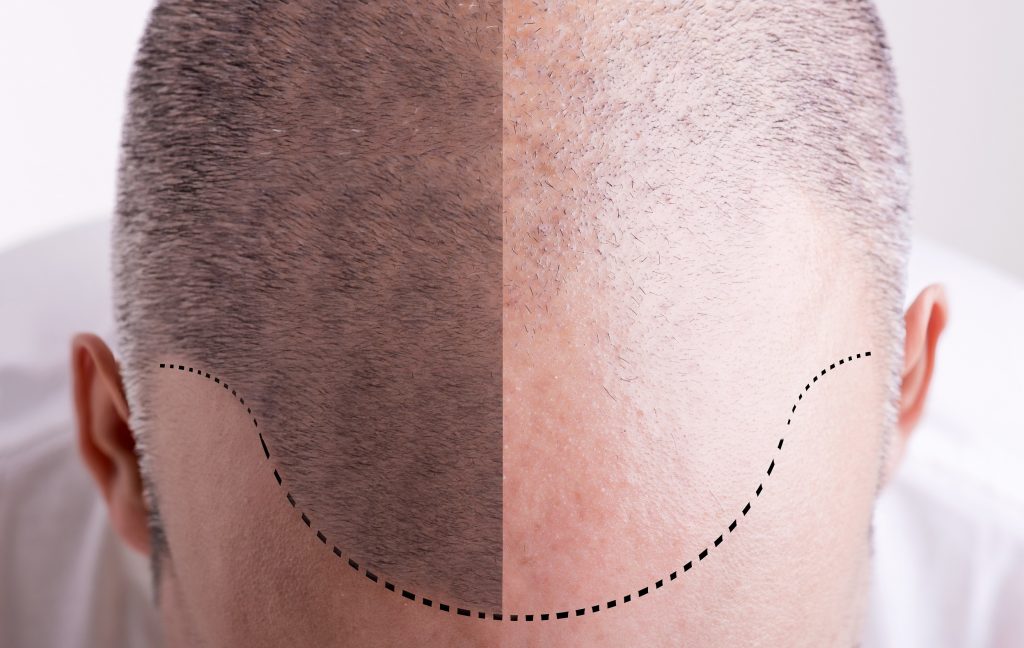 Hair Loss Treatment With Stem Cells